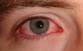 National Eye Hospital warns of rapidly spreading eye infection
